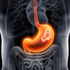 ​Get treated for H Pylori​