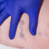 ​​What’s the cause of blue leg symptoms in COVID?​