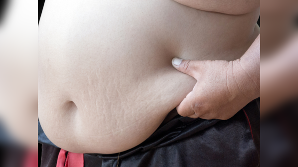 What is fatty liver?