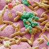 What is Listeria infection?