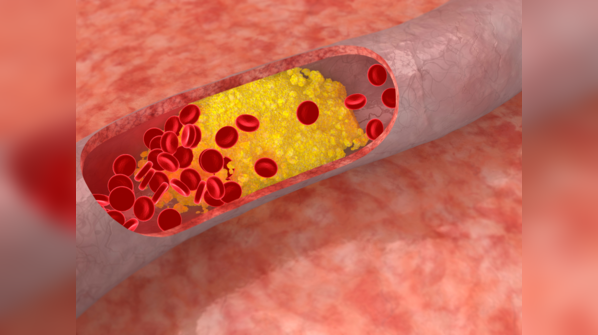 How bad cholesterol increases heart disease risk?