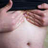 Hiatal hernia