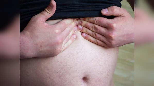 Hiatal hernia