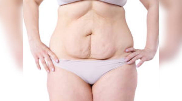Is weight loss surgery safe?