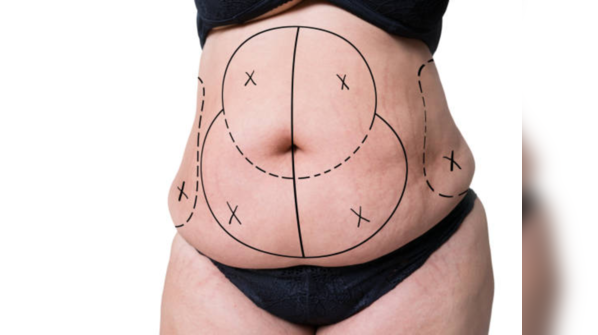 Adjustable gastric banding (Lap-band)