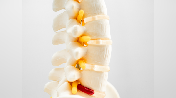 Tethered cord syndrome diagnosis and treatment