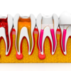 Article image for: <i class="tbold">root canal</i> aftercare is essential