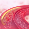 High cholesterol Symptoms: Causes, symptoms and how it affects the body