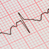 ​​Electrocardiogram (ECG)​