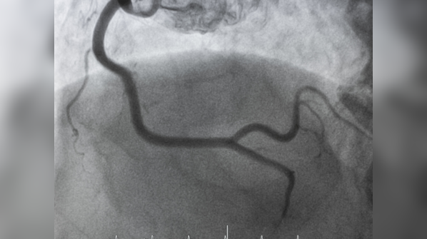 Coronary Angiography