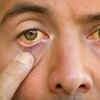 Yellowish tint on skin or eyes (Jaundice)