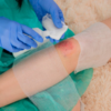​Infections and slow wound healing​