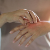 ​Blisters on hands, feet, legs​