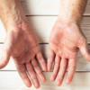 ​Scaly patches on the skin​