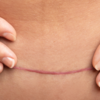 ​​Pelvic floor exercises​
