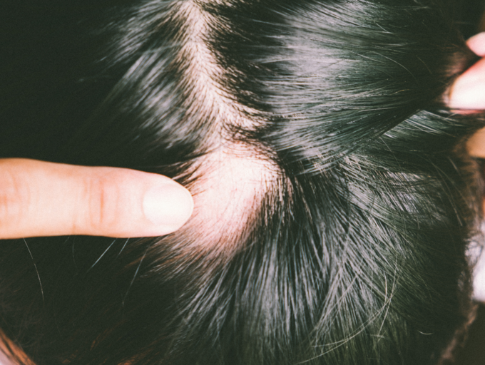 Experiencing hair loss in a small patch of head? It could be alopecia ...