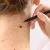 ​You have the same marks or spots