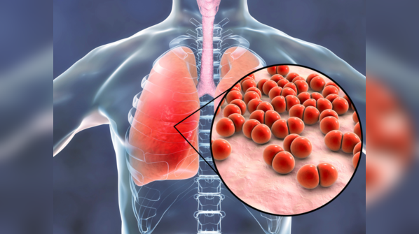 Understanding pneumonia and its impact