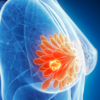 ​​Galactorrhea​