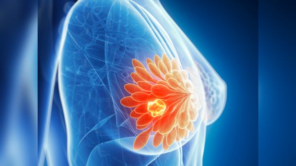 Galactorrhea
