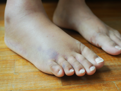 MS and Swollen Feet: Causes, Symptoms, and Treatment