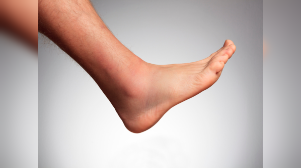 Sudden onset of weakness of lower limbs