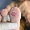 ​​Diabetic foot ulcers​