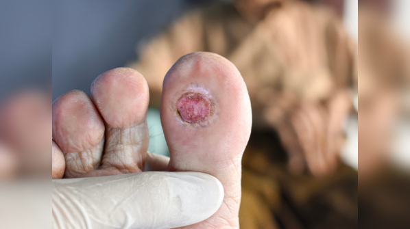 Diabetic foot ulcers