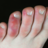 ​​Blackish discoloration for toes and foot​