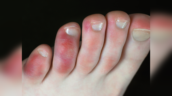 Blackish discoloration for toes and foot
