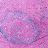 ​​Omphalitis​