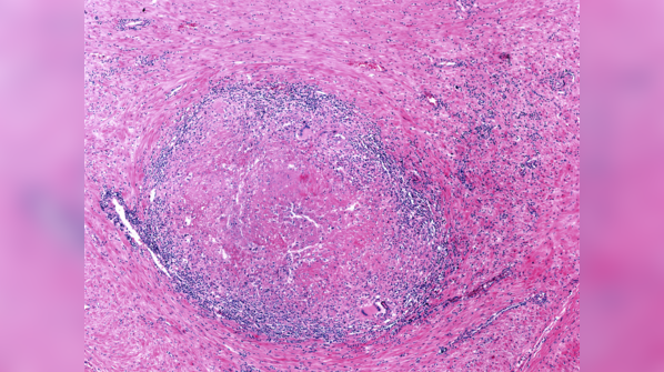 Omphalitis