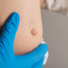​​Hernia​