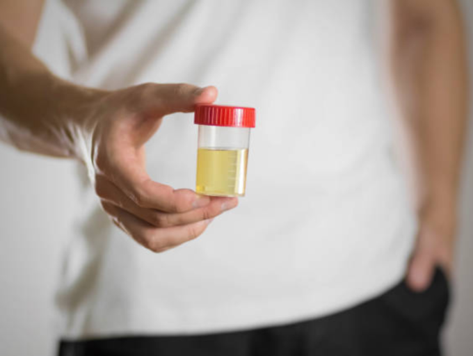 Yellow Urine Symptoms Why is urine yellow? Unraveling the science