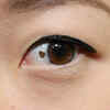 Eye Moles