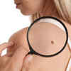 Back Moles