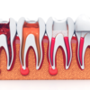 Article image for: Tips for brushing after <i class="tbold">root canal</i> treatment