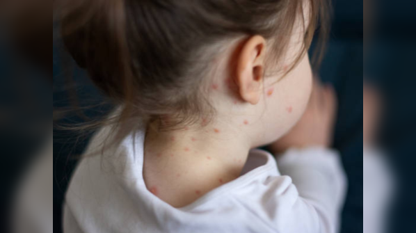 Measles cases are increasing