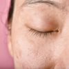 ​​Mask of pregnancy​