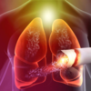 ​Increased risk of lung cancer​