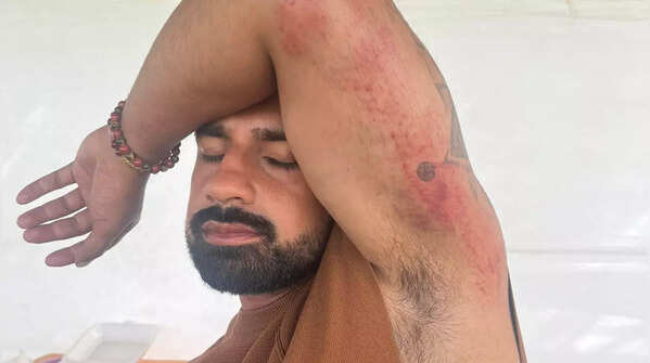 Aashish Mehrotra gets injured on the sets of Khatron Ke Khiladi 14