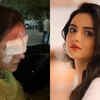 Jasmin Bhasin suffer corneal damage