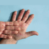 ​Is there a threat of monkeypox in India?​