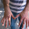 ​Complications associated with monkeypox​