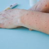 ​How to identify if it is monkeypox?​
