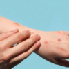 ​How does monkeypox virus spread?​