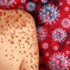 ​What is the current status of monkeypox? Where is its outbreak?​
