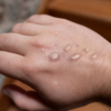 ​Swollen lymph nodes is typical to monkeypox​
