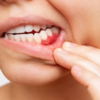 Bleeding gums, nosebleeds, easy bruising, etc.