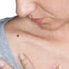 Melanoma